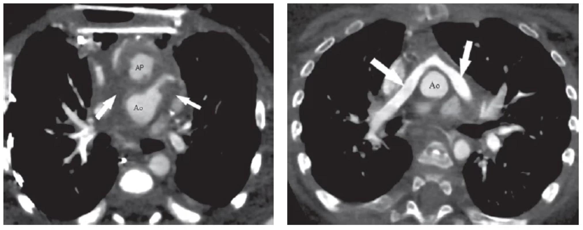 CTA u 2-týždňového pacienta s D-transpozíciou veľkých ciev po chirurgickej korekcii (arteriálny switch s LeCompte manévrom)
na ECMO (mimotelový obeh) pre závažnú hypoxémiu (pacient s otvoreným hrudníkom). CTA (obrázok vľavo) odhalilo kompletnú trombózu
oboch ramien pľúcnice (šípky ukazujú na miesta, kde by mali byť opacifikovné ramená pľúcnice). Pacient prežil iba vďaka alternatívnej
perfúzii pľúc prostredníctvom aortopulmonálnych kolaterál. Na základe CTA nálezu bola u pacienta realizovaná chirurgická trombektómia
s výborným efektom. Kontrolné CTA už po zatvorení hrudníka bez ECMO (obrázok vpravo). Šípky ukazujú na ramená pľúcnice obsadajúce
aortu po LeCompte manévri. Oba obrázky v axiálnej projekcii.