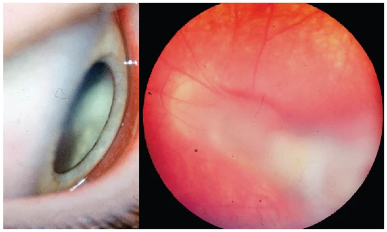Vlevo: Difúzní periferní vitreoretinální zánět toxokarové etiologie
Vpravo: Trakční vitreální pruh toxokárového granulomu táhnoucí se z periferie sítnice
k papile zrakového nervu