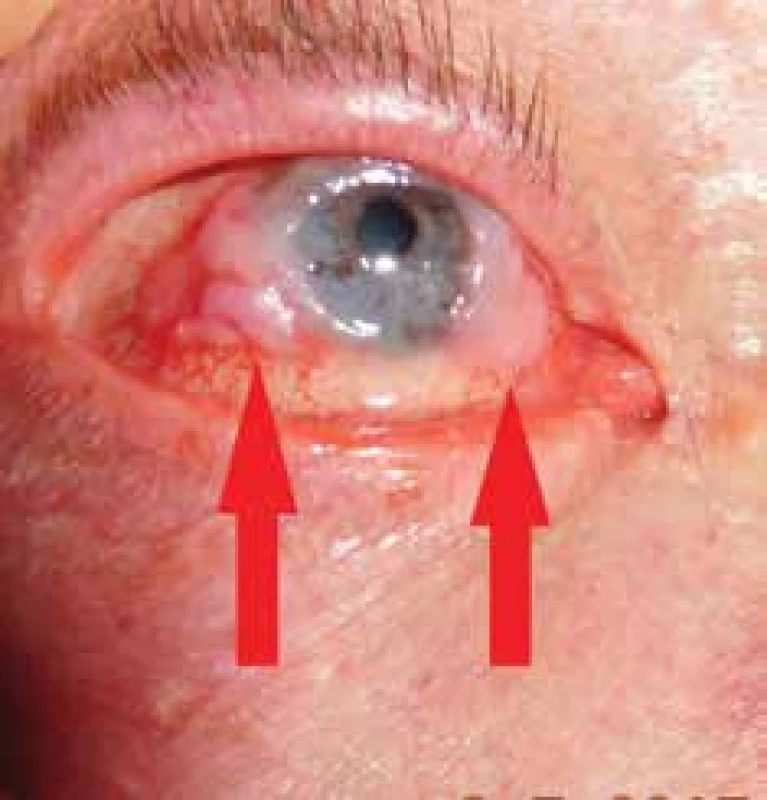 Clinical picture of a patient with squamous cell carcinoma
of bulbar conjunctiva