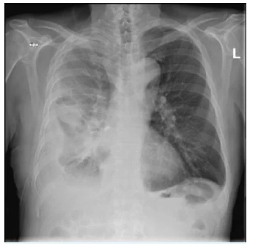 Komplikovaný parapneumonický výpotek u stejného
pacienta po zadrénování
