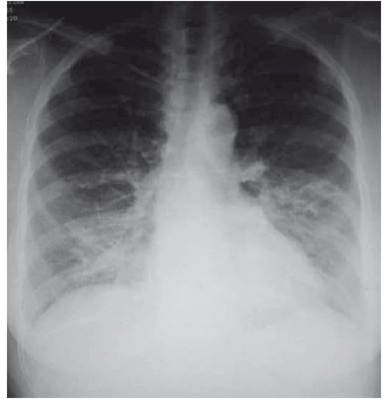 Pneumonie vpravo bazálně.<br>
Fig. 2. Right basal pneumonia.