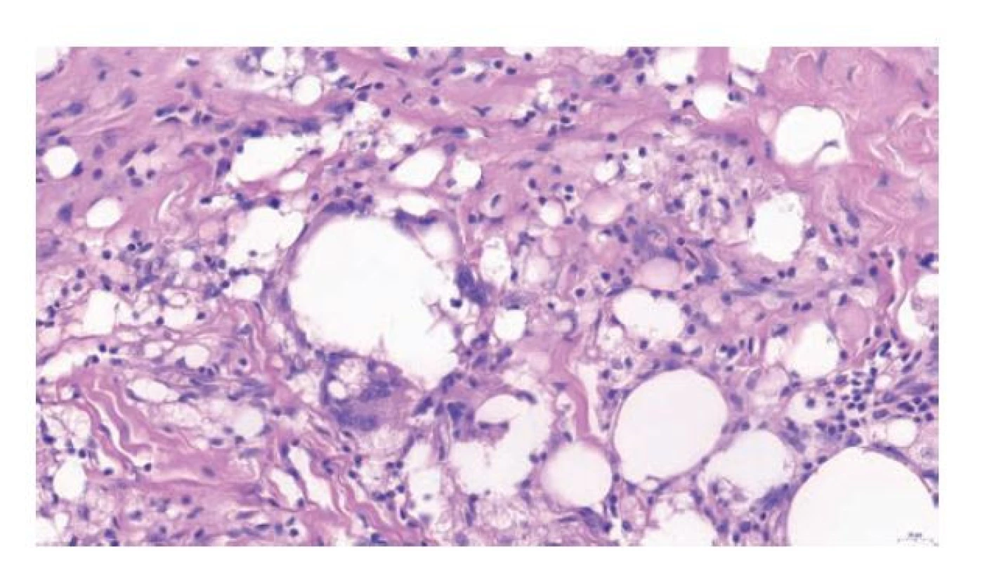 Granulom typu z cizích těles v okolí parafínových depozit, s účastí
pěnitých makrofágů a obrovských vícejaderných buněk. Hematoxylin eosin,
47.9x.