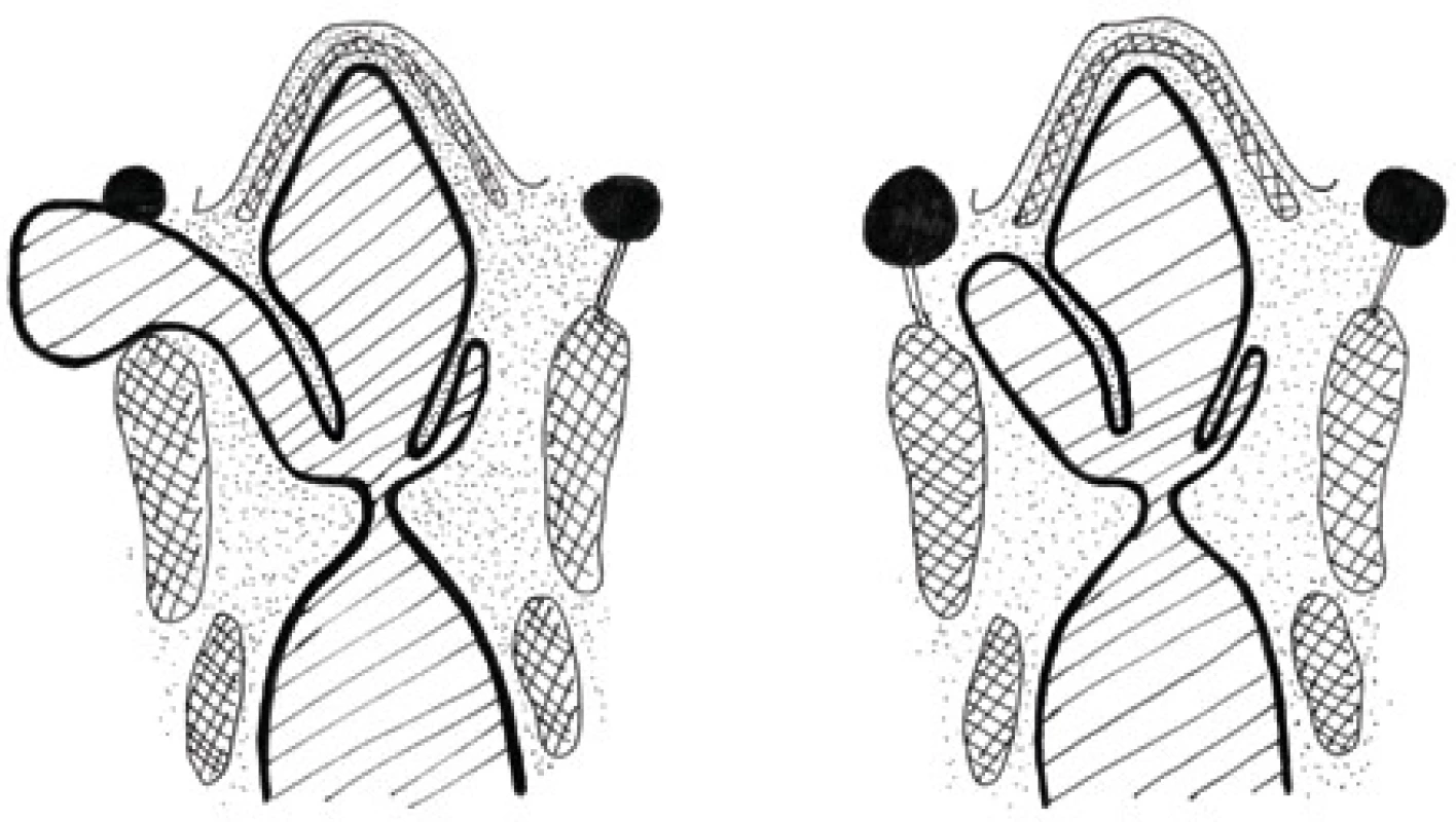  Smíšená (vlevo) a vnitřní (vpravo) laryngokéla