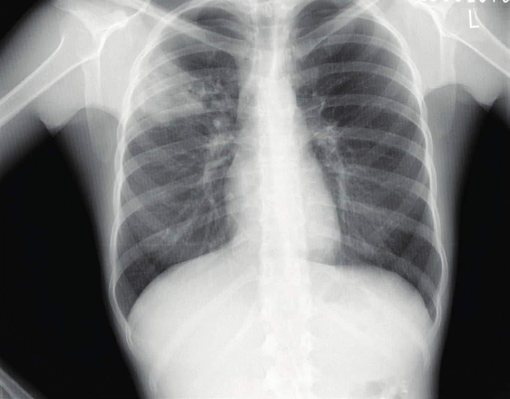 SKG hrudníku 17leté dívky. TB pneumonie vpravo, forma pneumonická mikroskopicky negativní, kultivačně
pozitivní.<br>
Fig. 2. Chest X-ray of 17 years old girl with pulmonary TB.