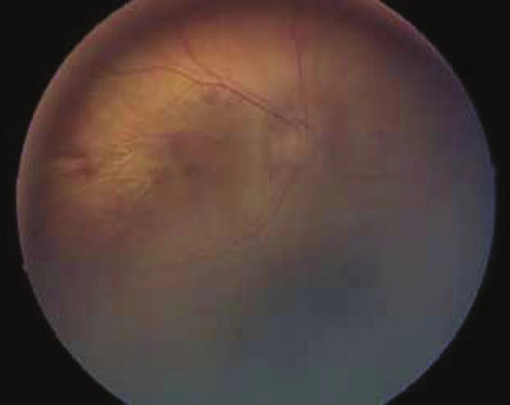 Očné pozadie u pacientky s Marshall/Sticklerovým syndrómom,
ĽO. Popis viď tab. č. 2