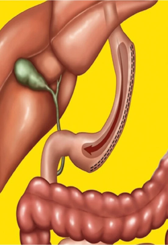 Tubulizace žaludku – sleeve gastrectomy