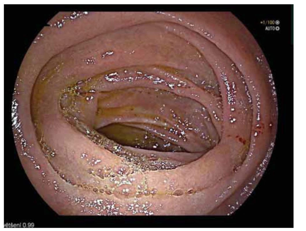 Endoskopické vyšetření po chirurgické resekci. Viditelná klidná, široká
anastomóza s fyziologickou sliznicí tenkého střeva.<br>
Fig. 5. Endoscopy after surgical resection. Visible calm, broad anastomosis with
physiological mucosa of the small intestine.