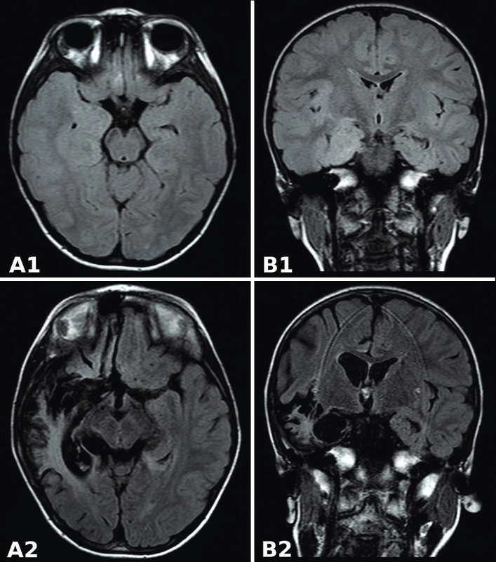 MR FLAIR mozgu. A1 a B1: pred liečbou acyklovirom. Signálové zmeny temporomediálneho kortexu s prevahou vpravo. A2 a B2: 9 mesiacov po HSE. Malatické zmeny, leukoencefalopatia v pravom temporálnom laloku, dilatácia pravej mozgovej komory. <br>
Fig. 1.  MR FLAIR of brain. A1 and B1: before acyclovir treatment. Signal changes of the temporomedial cortex with the right-side predominance. A2 and B2: 9 months after HSE. Malatic lesions, leukoencephalopathy in the right temporal lobe, dilatation of the right ventricle.