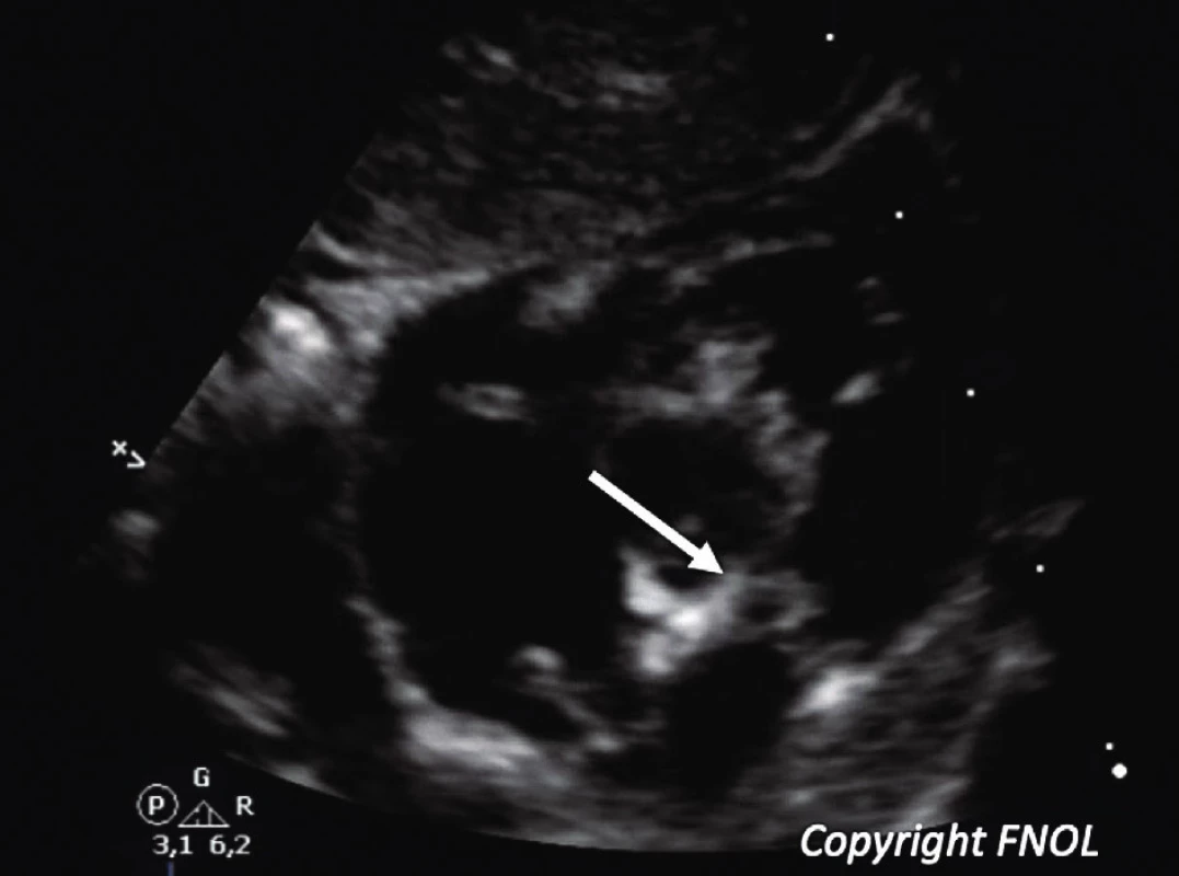 Echokardiografický 2D obraz dysplastické chlopně plicnice s hemodynamicky
středně významnou stenózou chlopně plicnice (šipka) u kojence s NS, parasternální krátká osa.<br>
Fig. 1. Echocardiographic 2D scan of a dysplastic pulmonary valve causing mild pulmonary valve stenosis (arrow) in infant with NS; parasternal short view.