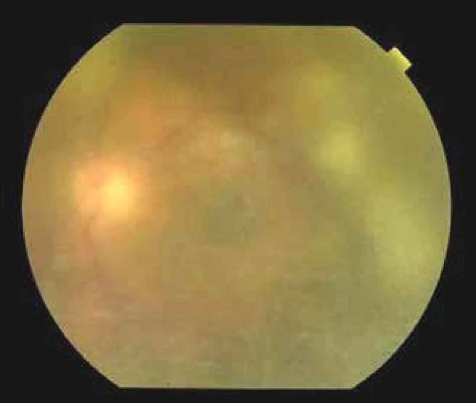 Finding on ocular fundus of left eye, regression of
exudation in vitreous body with showing through of an
optic nerve disc 7 days after commencement of therapy