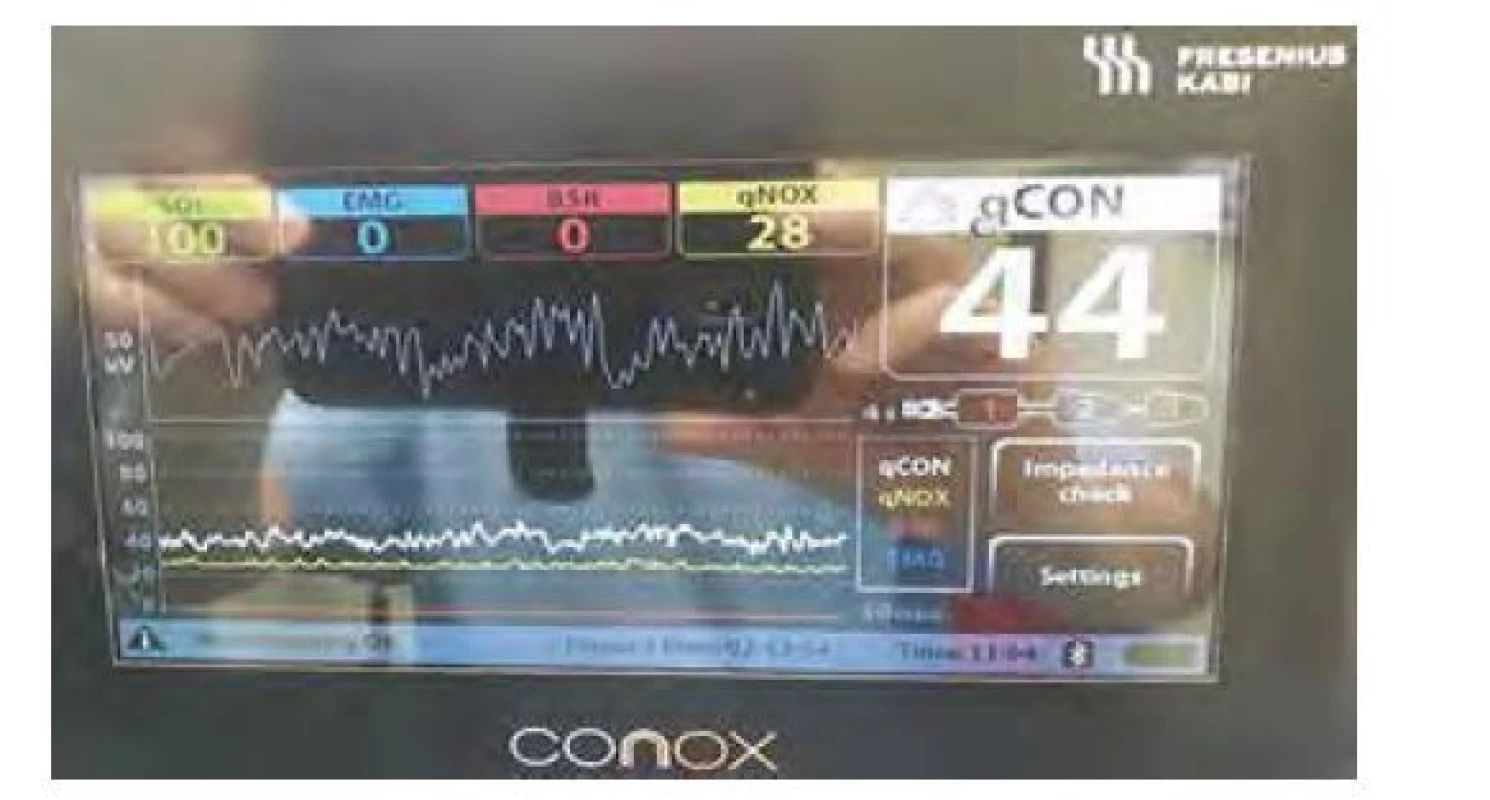Displej monitoru CONOX ukazuje nad syrovou křivkou EEG kvalitu
signálu (SQI), EMG aktivitu, BSR a indexy qNOX (ukazatel antinocicepce,
v rozmezí 40–60 je reakce pacienta na nociceptivní podnět nepravděpodobná)
a qCON (doporučené rozmezí pro anestezii 40–60). V dolní části je
zobrazen trend jednotlivých parametrů v období 60 minut