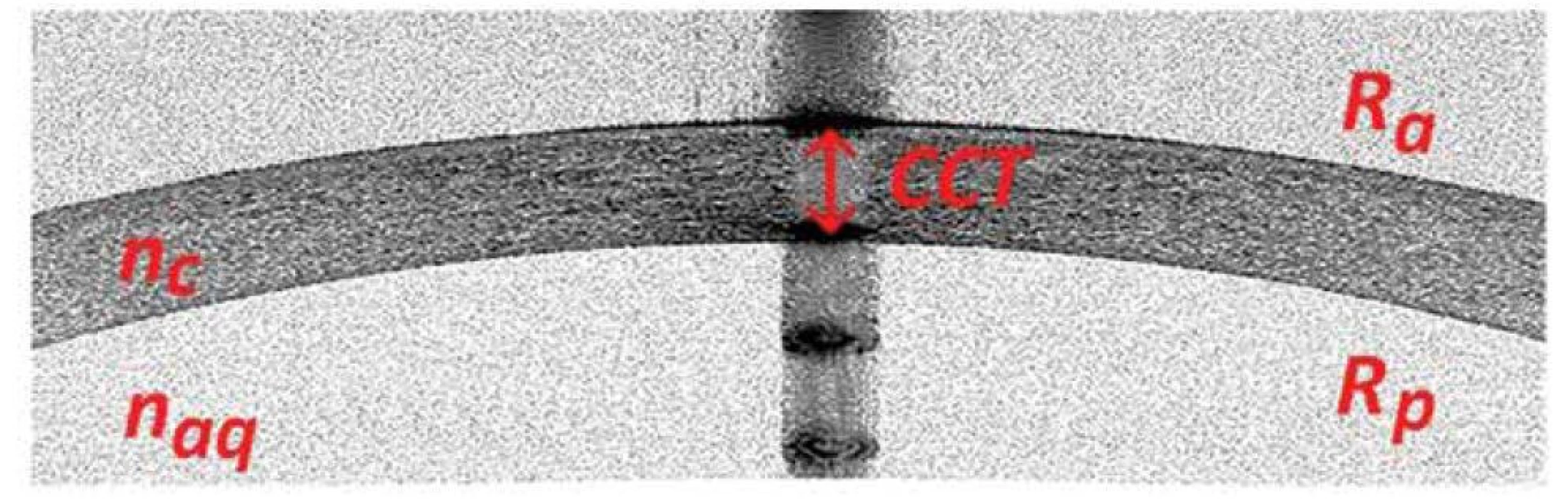 Ukázkový snímek tomografického řezu centrální části rohovky o průměru 3 mm<br>
Ra – radius přední plochy rohovky, Rp – radius zadní plochy rohovky, nc – index lomu rohovky, naq – index
lomu komorové tekutiny, CCT – centrální pachymetrie