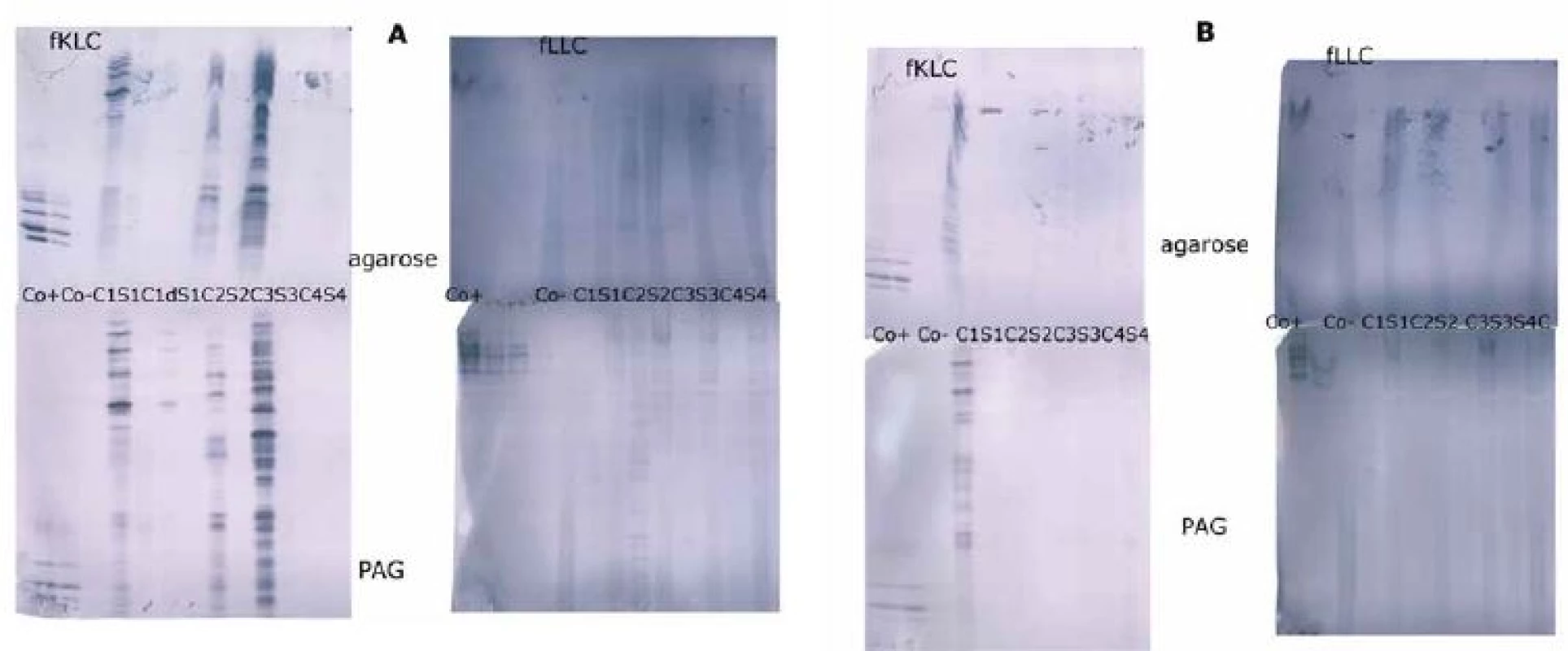 Oligoclonal free light chains.
A) Concordant results between agarose and PAG IEF/AIB. C1, C2 and C3 are clearly positive for oligoclonal fKLC while only C2 is clearly positive for oligoclonal fLLC. In C1 sample, two faint cerebrospinal fl uid-restricted fLLC bands were found on the membrane after PAG IEF/AIB, while the evaluation was discrepant for agarose IEF/IF (two bands by observer A, one band by observer B). Sample C4 is negative.
AIB – affinity immunoblotting; C1–4 – paired undiluted cerebrospinal fl uid samples; C1d – cerebrospinal fl uid 1 diluted 1/10 (for fKLC only); Co+ – positive control (monoclonal free light chains [Bio-Rad – AbD Serotec, Prague, Czech Republic] diluted to 0.25 and 0.10 mg/l for fKLC and 1.0, 0.5, 0.25 and 0.10 mg/l for fLLC); Co– – negative control (intravenous immunoglobulin G remedy at a concentration of 250 mg/lIgG); fKLC – free kappa light chains; fLLC – free lambda light chains; IEF – isoelectric focusing; IF – immunofi xation; PAG – polyacrylamide gel; S1–4 – paired serum samples diluted 1/80 (except for S1 next to neat C1 that was diluted 1/20 for fKLC analysis)
(B) Example of a discordant result of fLLC between agarose and PAG IEF/AIB. There are numerous fKLC bands in sample C1, whereas faint fLLC bands were only found on PAG IEF/AIB (two bands by observer A, three bands by observer B). Co+ is diluted to 0.25 and 0.10 mg/L for fKLC and 1.0 and 0.25 mg/L for fLLC. AIB – affinity immunoblotting; fKLC – free kappa light chains; fLLC – free lambda light chains; IEF – isoelectric focusing; PAG – polyacrylamide gel