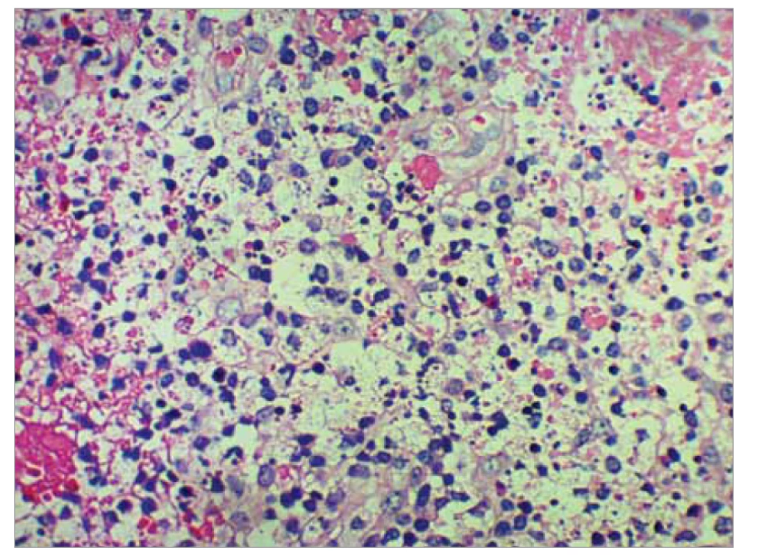Nekróza tkaniva uzliny so zastúpením lymfocytov, početných histiocytov
a neutofi lov vo väčšom priblížení (farbené hematoxilínom eozínom, zväčšenie
pri obj. 40).<br>
Fig. 5. Necrosis of nodal tissue with a representation of lymphocytes, numerous
histiocytes and neutrophils in a larger approximation (stained with hematoxylin
eosin, magnification at volume 40).