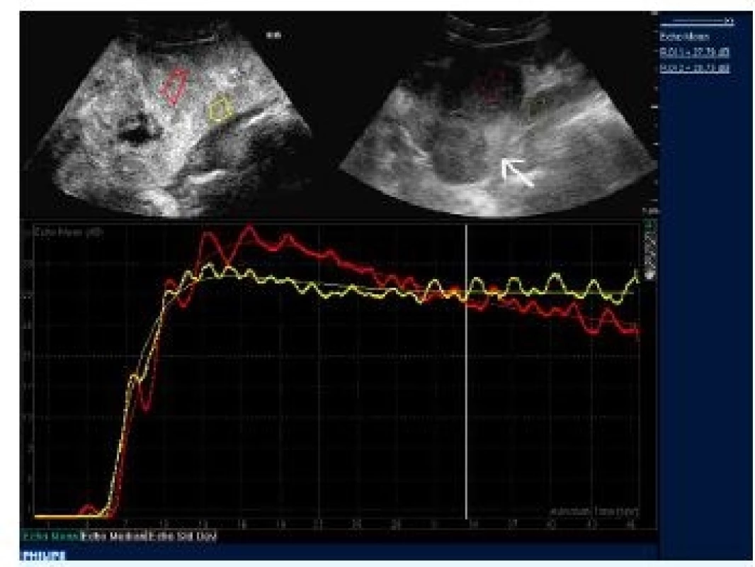 Karcinom ledviny v kontrastním ultrazvukovém zobrazení včetně kvantifikace průtoků.