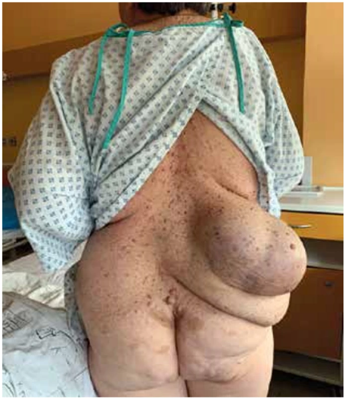 Fotografie pacientky s lumbální kýlou před operací <br>
Fig. 1. Photography of the patient with lubar hernia before the operation