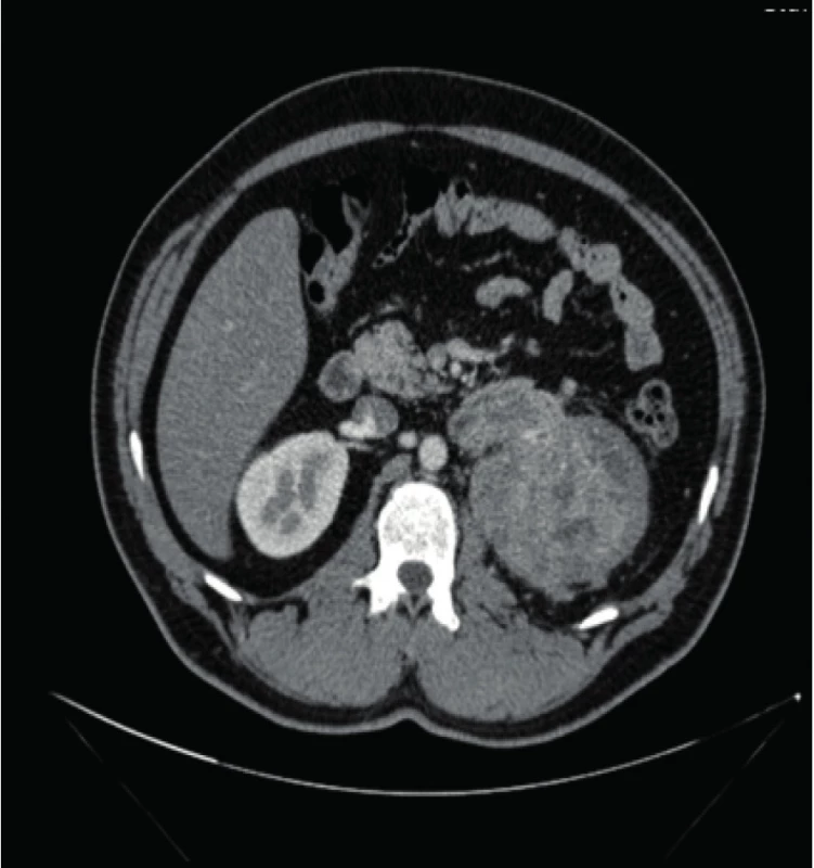 CT nález tumoru levé ledviny s nádorovým
trombem renální žíly a postižením uzlin<br>
Fig. 1. CT finding of the left kidney with tumor, tumor
thrombus of the renal vein and nodal involvement