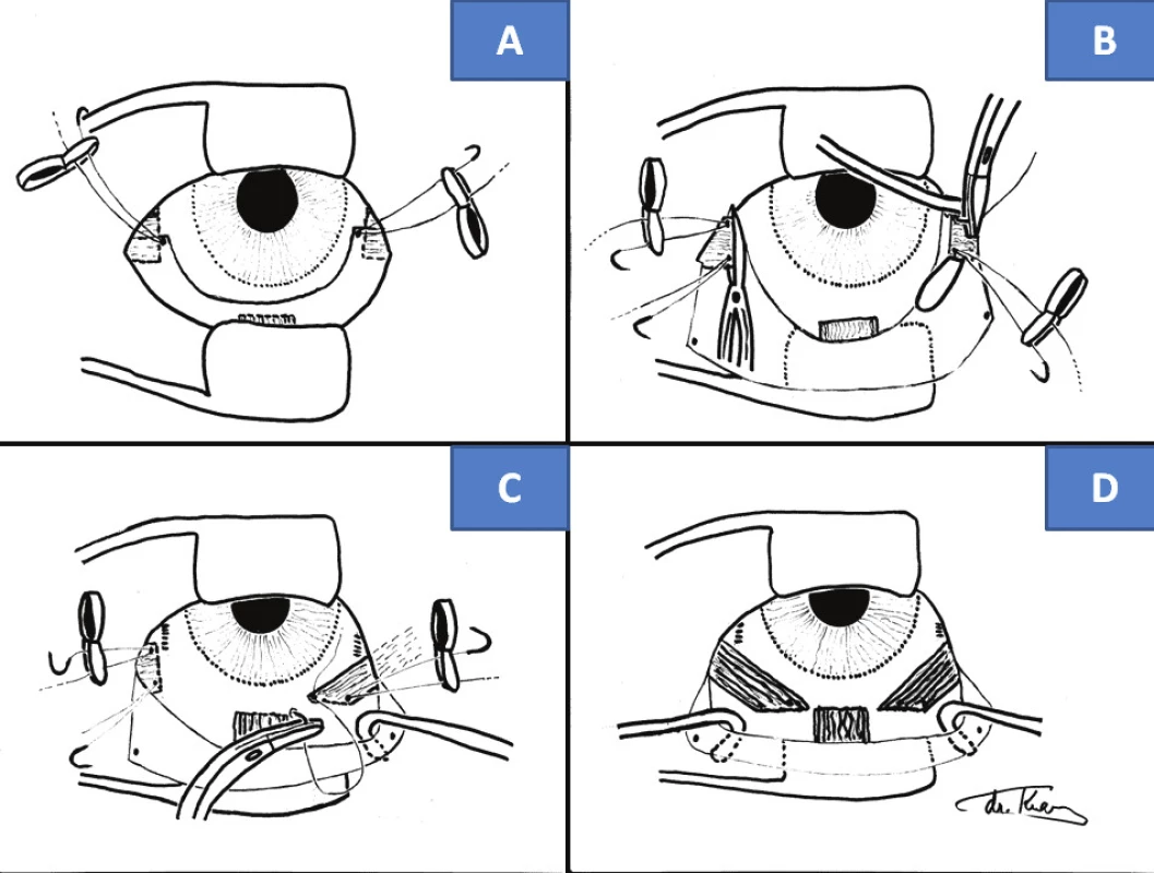 Surgical technique of “anticlockwise” transposition according to Knapp procedure: scope of incision of bulbar conjunctiva (A), fixation of sutures and cutting off of horizontal rectus muscles (B), fixation of horizontal rectus muscle by tendon of inferior rectus muscle (C), fixing of both horizontal rectus muscles on level of tendon of inferior rectus muscle (D)