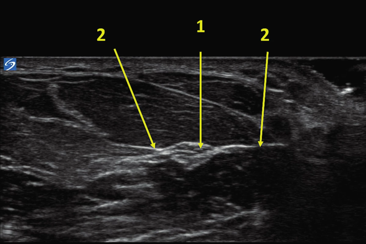 UZ obraz n. medianus<br>
1 – nervus medianus, 2 – fascie mezi povrchními a hlubokými
flexory ruky