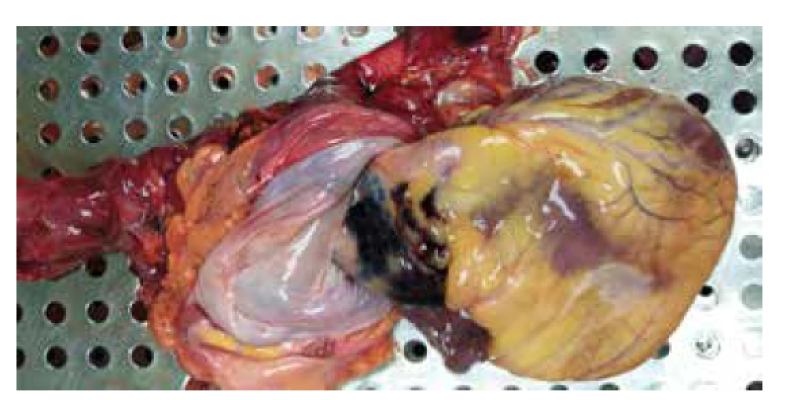 Hematom v oblasti ascendentní aorty. <br>
Fig.1. Hematoma of ascending
aorta.