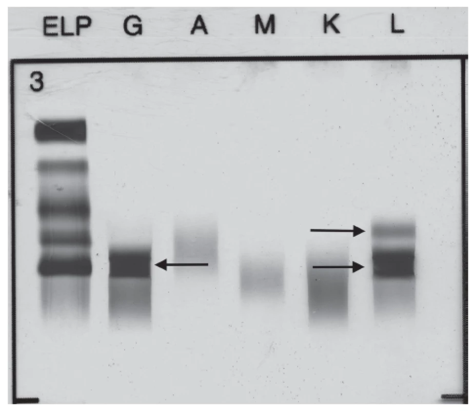 Immunofixation electrophoresis of patient´s serum sample
presenting paraprotein IgG Lambda and FLC Lambda.
