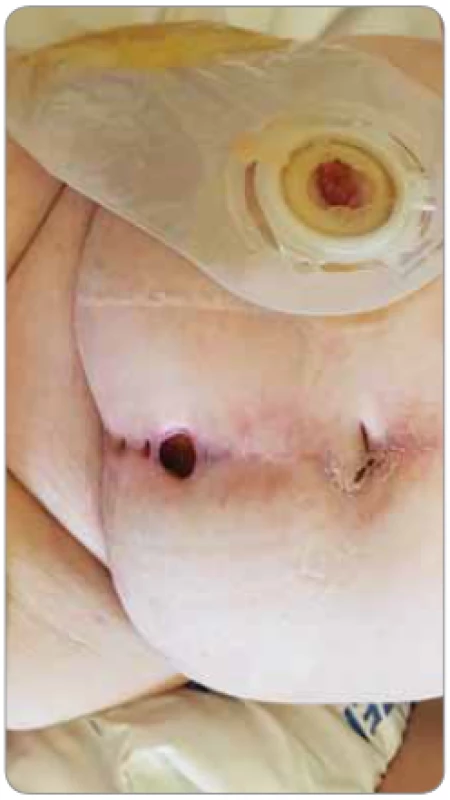 Nehojící se rána v souvislosti s cystektomií
dle Brickera pro uroteliální karcinom
močového měchýře (foto S. Vokurka,
FN Plzeň).
