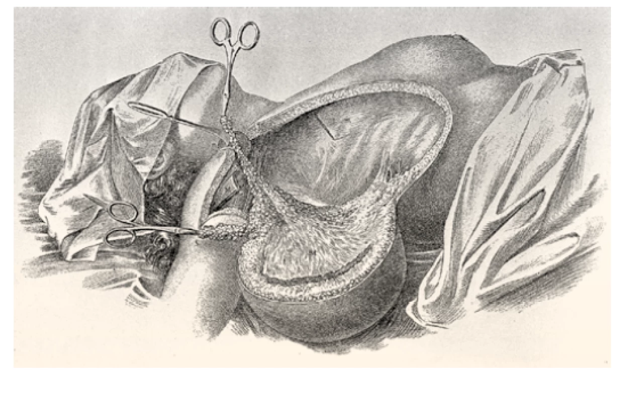 Radikální mastektomie dle Halsteda. Zdroj: Wikimedia Commons
(CC BY 4.0)