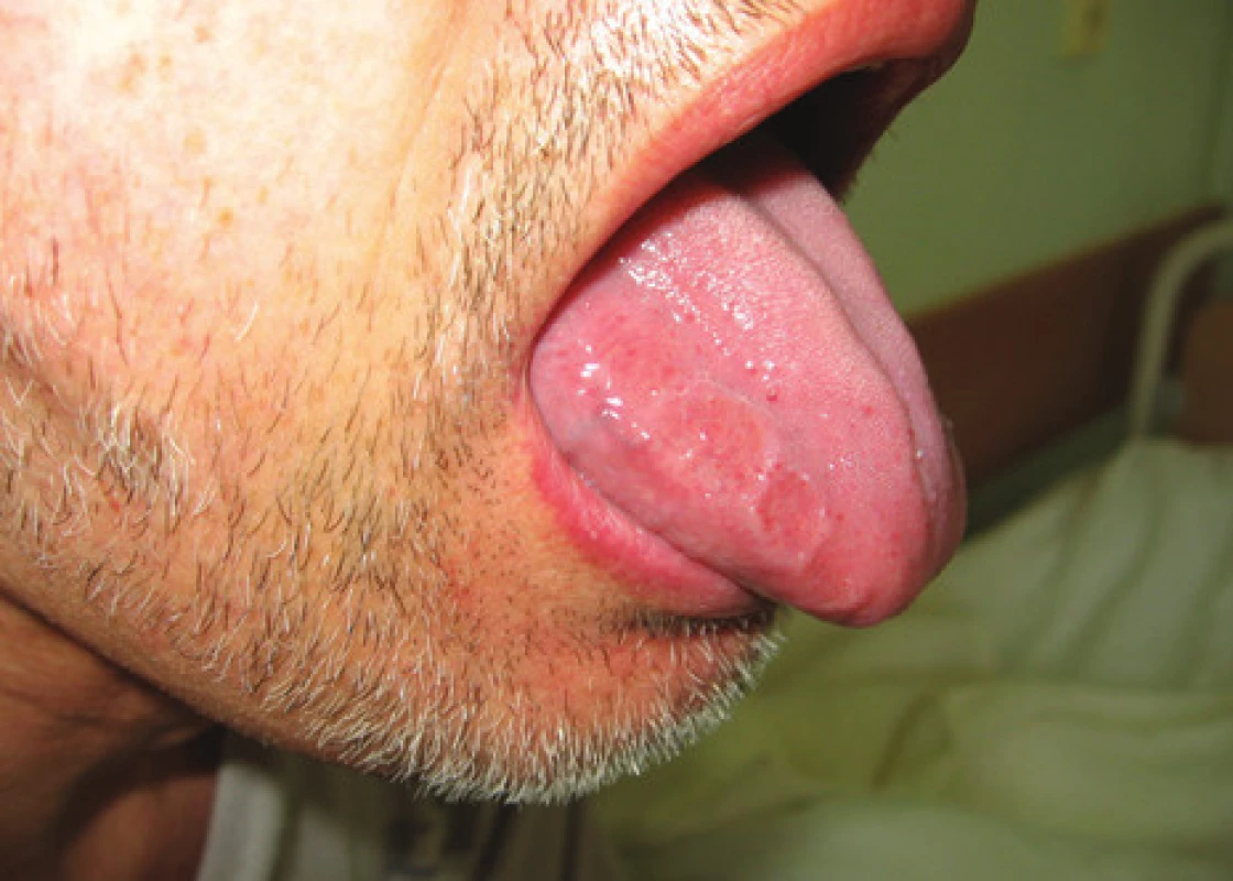 Infitrace jazyka při AL amyloidóze s imprinty zubů.<br>
Fig. 1. Tongue infiltration with AL amyloidosis with tooth imprints.