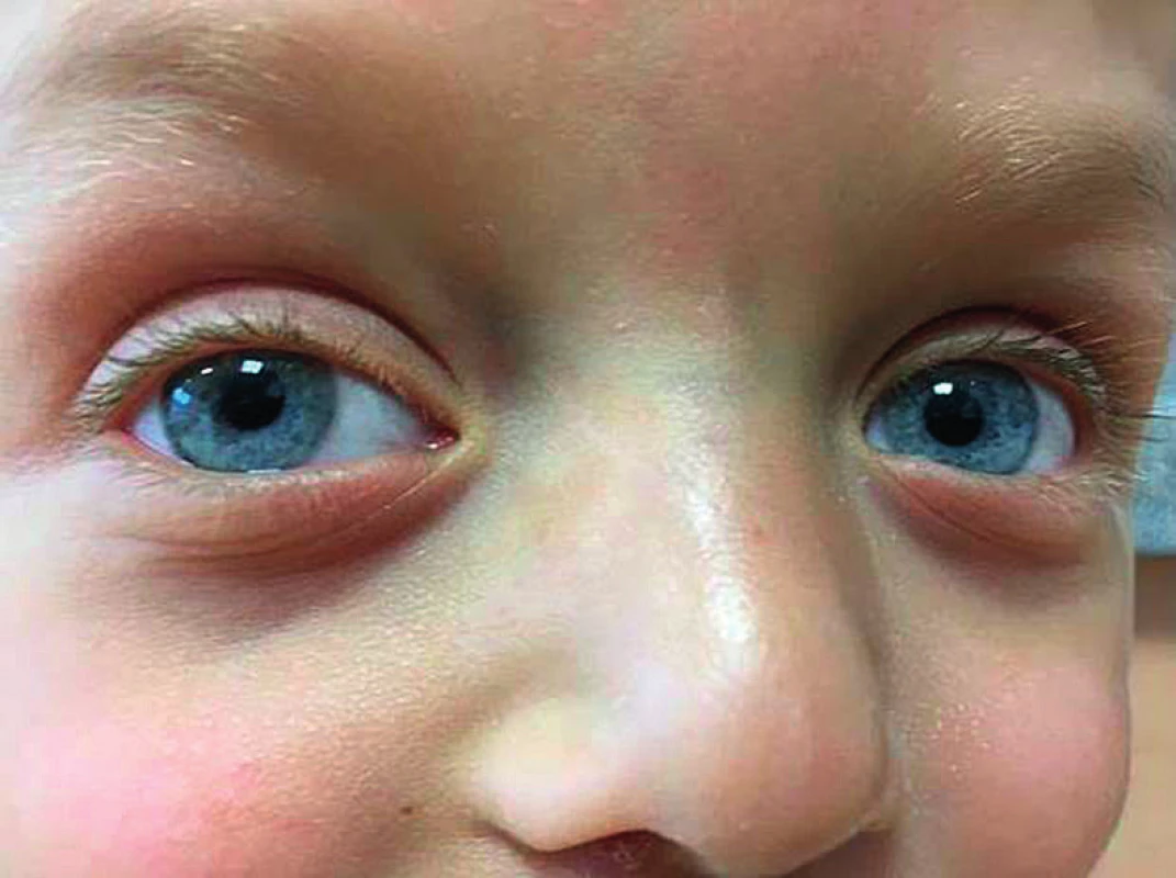 Nápadně modré oči u chlapce se syndromem
Noonanové a patogenní variantou genu PTPN11. Oba
rodiče mají oči hnědé.<br>
Fig. 2. Strikingly bluish eyes in a boy with Noonan syndrome
due to a pathogenic PTPN11 gene variant. In both parents, their eyes are brownish.