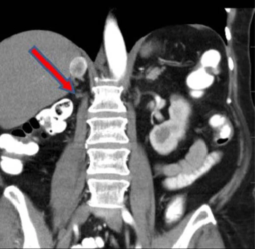 Metastáza nadledviny vpravo
dle CT z druhé poloviny května 2016<br>
Fig. 2. Metastasis of adrenal gland
right – CT May, 2016