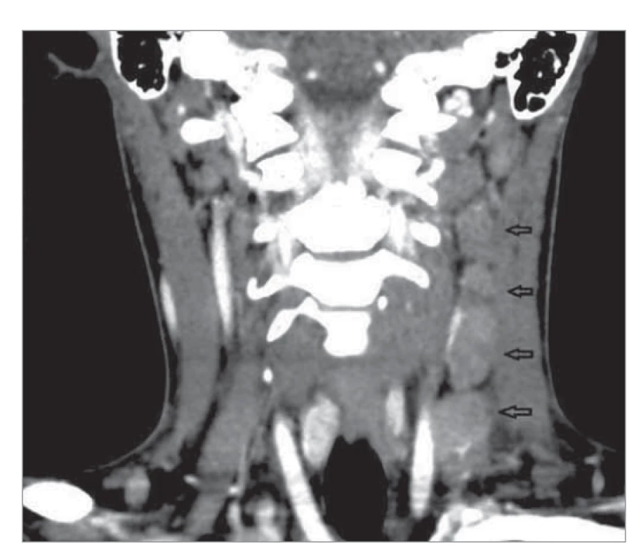 CT sken krku odhaľuje zväčšené lymfatické uzliny
pozdĺž m. sternocleidomastoideus vľavo (koronárny rez).<br>
Fig. 2. A CT scan of the neck reveals enlarged lymph
nodes along the left sternocleidomastoid muscle
(coronary incision).