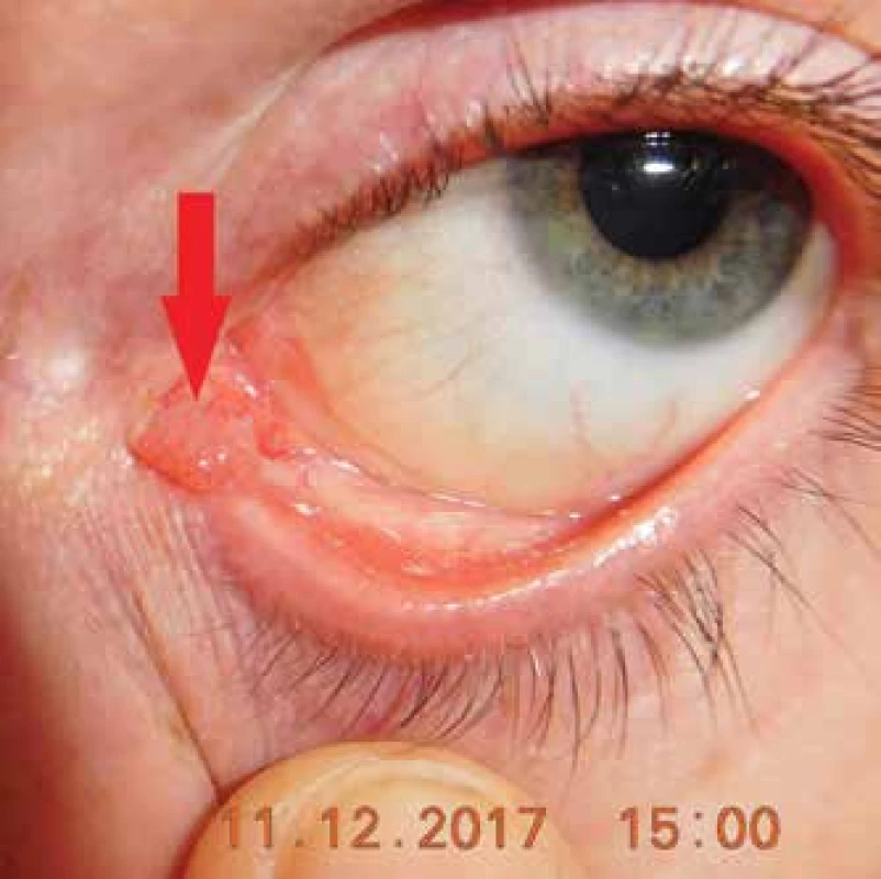 Clinical picture of a patient with papilloma of caruncula