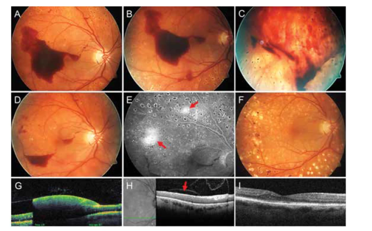 Subhyaloidní krvácení na pravém oku pacientky č. 2 (A), bezprostředně po
provedené Nd:YAG laserové hyaloidotomii (B, C), týden po provedené Nd:YAG laserové
hyaloidotomii (D), pozdní fáze fluorescenční angiografie (E) s aktivními neovaskularizacemi
sítnice (označeny šipkami), stabilizovaný nález po 27 měsících (F). Lineární
transfoveolární horizontální sken pomocí optické koherenční tomografie dokumentuje
subhyaloidní krvácení (G), lineární horizontální inferoextrafoveolární sken s reziduální
subhyaloidní kapsou (označena šipkou) za 1 měsíc (H) a lineární horizontální transfoveolární
sken 27 měsíců po provedené Nd:YAG laserové hyaloidotomii (I)