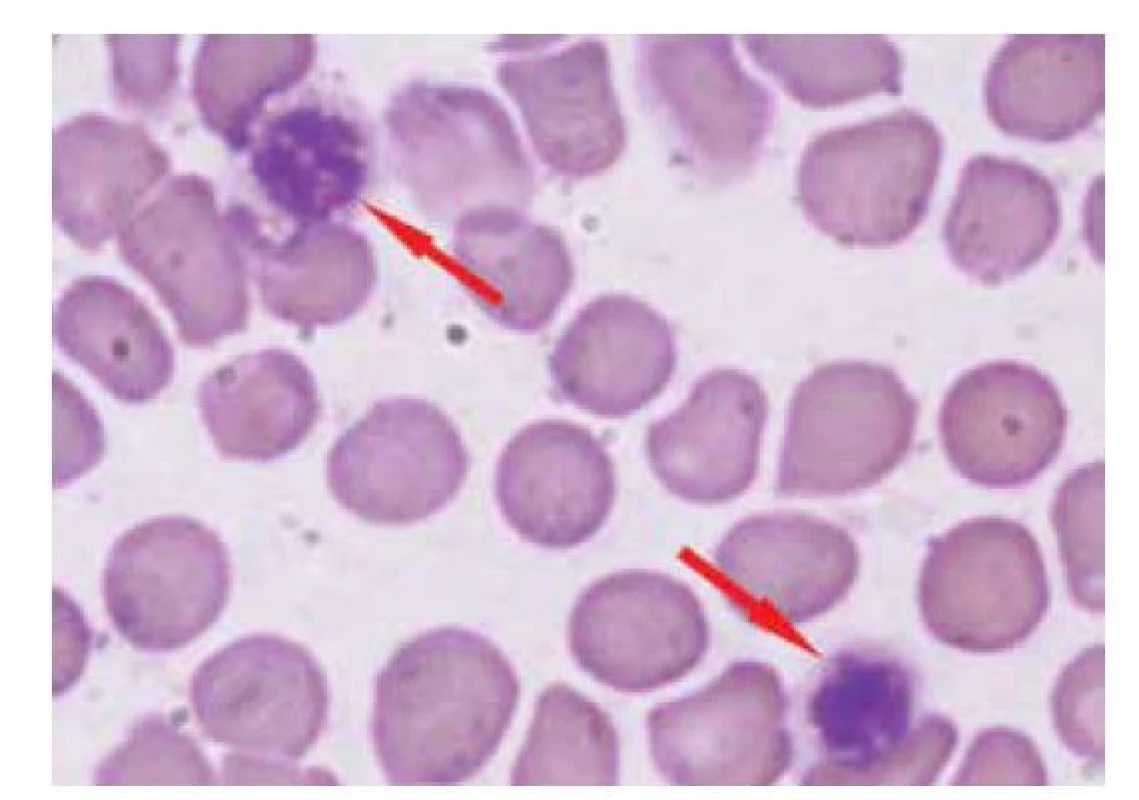 Velké trombocyty dosahující velikosti erytrocytů – tyto
velké trombocyty jsou v analyzátoru krevních elementů chybně
počítány jako erytrocyty, což má za následek falešně nízký
počet trombocytů (kojenec s May-Hegglinovou anomálií).<br>
Fig. 1. Large platelets are equal to an erythrocyte size – these
large platelets are miscounted as erythrocytes by a hematology
analyzer, which results in a false low platelet count (here,
an infant with May-Hegglin anomaly).