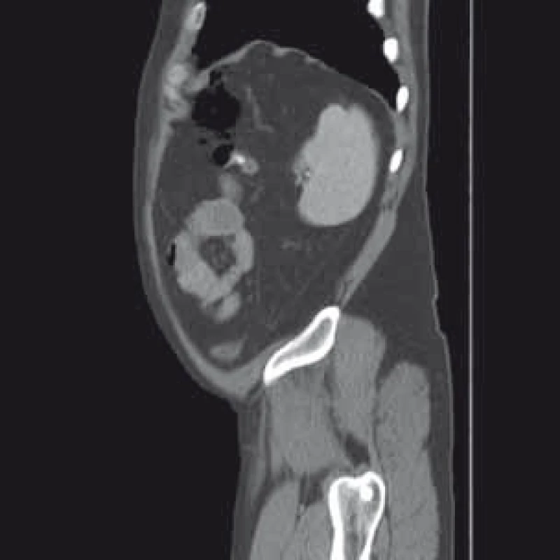 Kontrastní CT vyšetření břicha – sagitální řez.