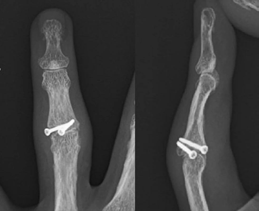 Snímek po zhojení a ukončení RHB, prominence šroubů do kloubu, posttraumatická artróza