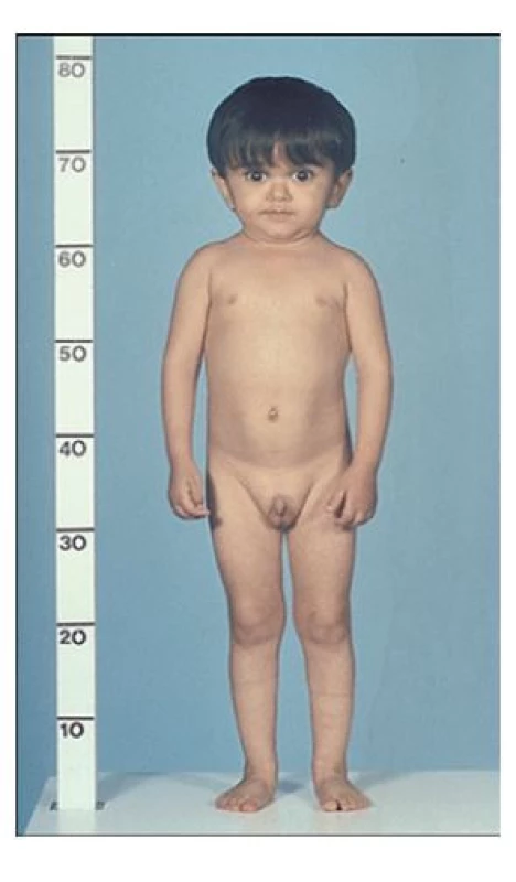 Fenotyp chlapce s necitlivostí
k růstovému hormonu
(Laronovým syndromem)
v důsledku patogenní
varianty GHR genu
