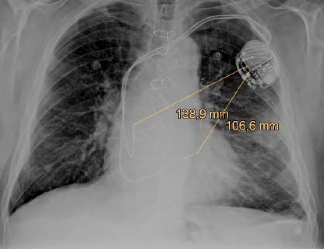 The anteroposterior x-ray projection of the dual
chamber pacemaker with figured pace/sense vectors.