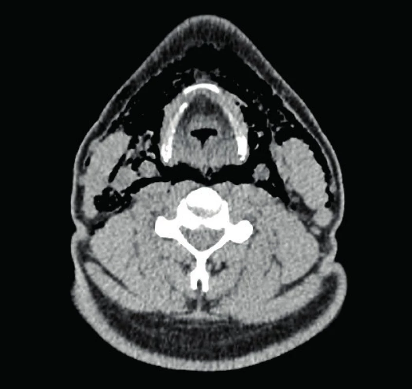 CT snímek krku (axiální rovina)