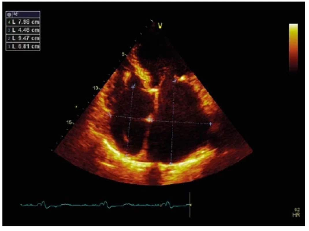 Echokardiografický obraz restriktivní kardiomyopatie. Apikální
čtyřdutinová projekce. Významná dilatace obou srdečních síní
