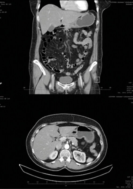 CT břicha: cirkulární zúžení lumen a zesílení stěny žaludku na 
rozhraní žal. těla a antra