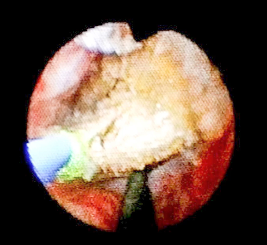 Peroperační foto – pohled ureteroskopem na
konkrement při trypsi v distálním ureteru (na č. 6 jistící
drát, na č. 8 laserové vlákno)<br>
Fig. 4. Peroperative photo – ureteroscopic view at the
stone in distal ureter during endoscopic trypsy (at six
o´clock guidewire, at eighl o´clock laser fiber)