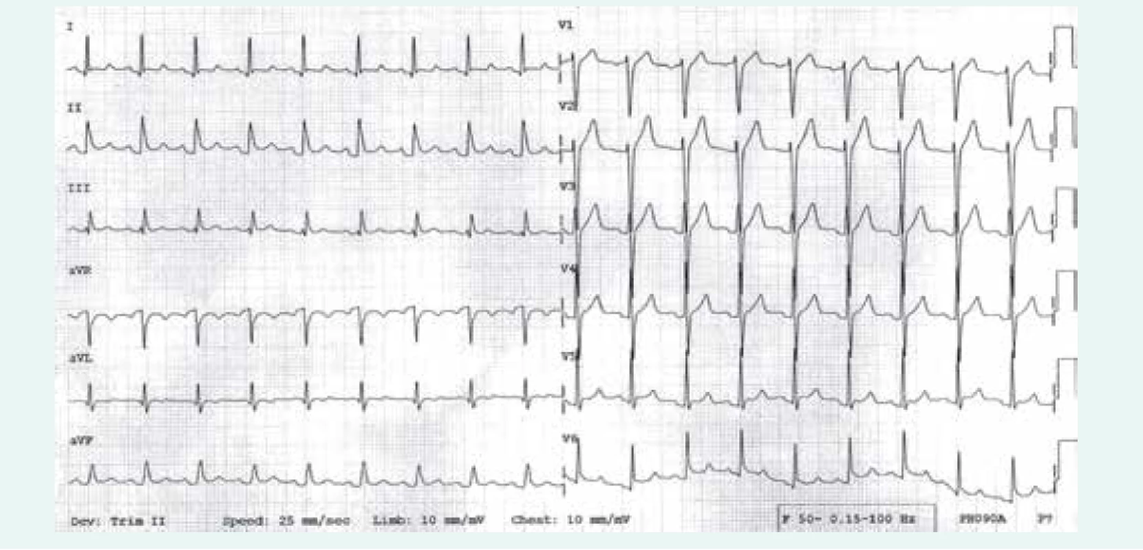 EKG nález u nemocného s akutní perikarditidou: patrny jsou difuzní, vzhůru konkávní elevace ST úseku,
doprovázené depresemi úseku PR (1. fáze EKG změn)