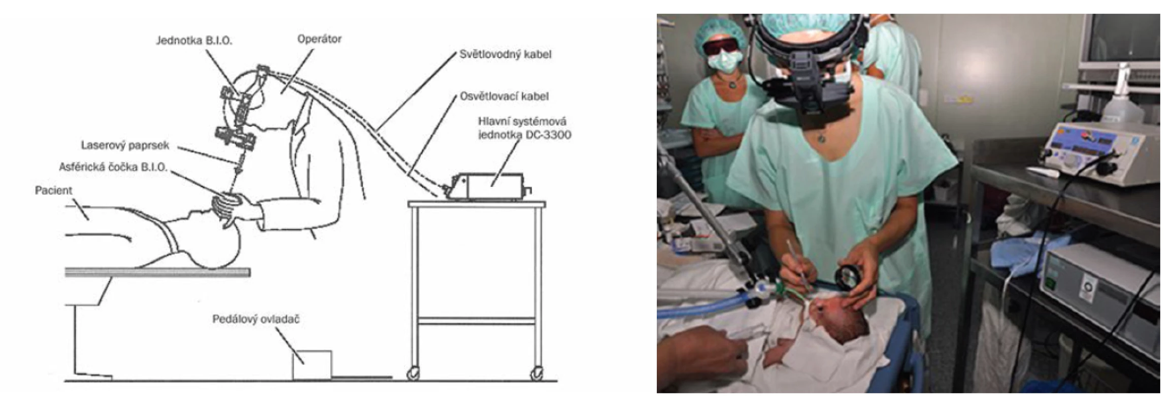 Transpupilární operace sítnice diodovým laserem s nepřímou oftalmoskopií