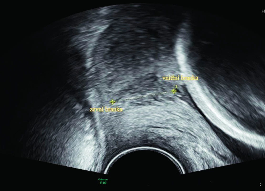 Transvaginální ultrazvuk děložního hrdla