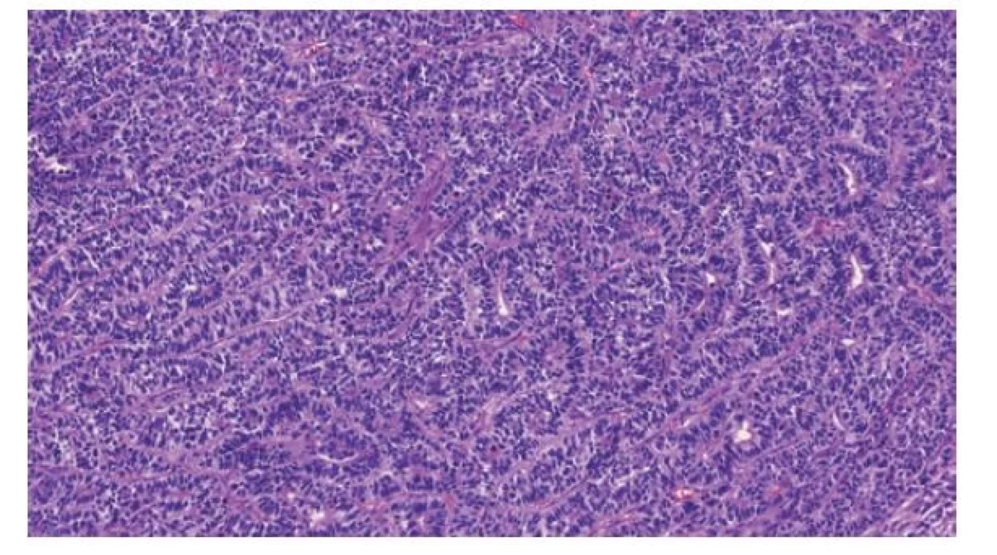 Charakteristickým histologickým obrazem neuroektodermálního
tumoru embryonálního typu (ENET) jsou tubulárně a rozetovitě uspořádané
primitivní neurální buňky s hyperchromními jádry a malým množstvím
cytoplazmy.