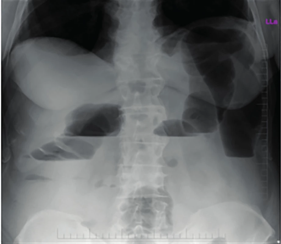Natívna RTG snímka brucha v stoji s nálezom ileu
hrubého čreva<br>
Fig. 1: Native abdominal X-ray with finding of the large
bowel obstruction