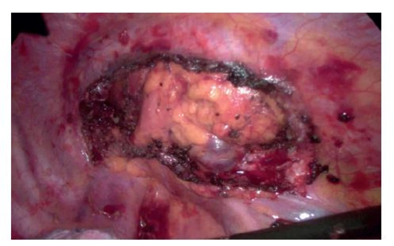 Výsledný stav po resekci prvního žebra<br>
Fig. 5: Exposure after removal of the first rib