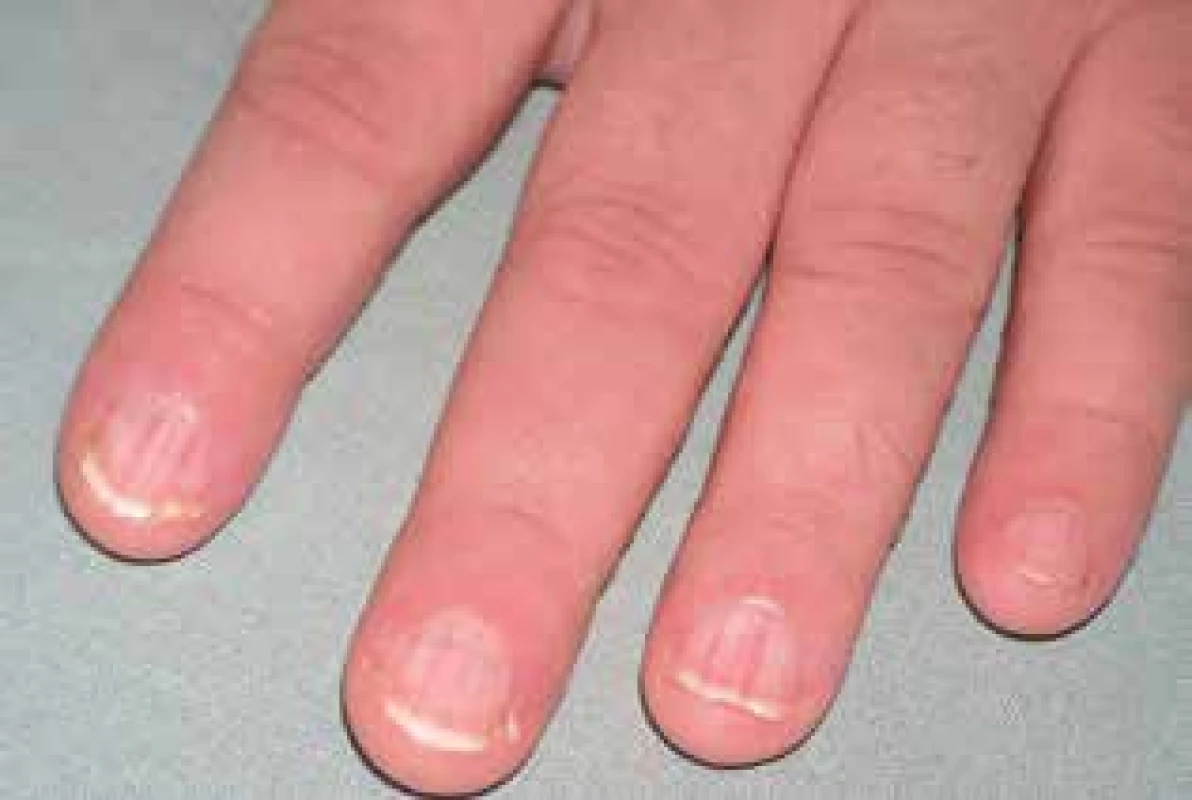 Typické postižení nehtů rukou s podélnou erytro/leukonychií