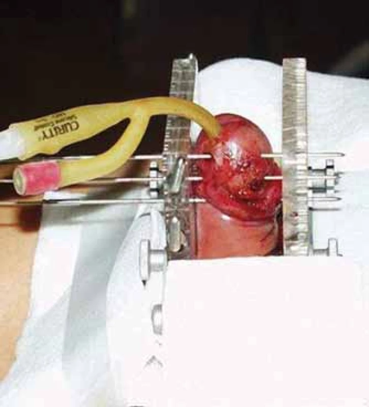 Aplikace brachyterapie s vysokým
dávkovým příkonem karcinomu penisu.